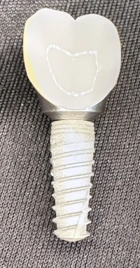 dental implants in Vienna, VA