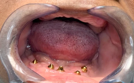 all-on-x attachments