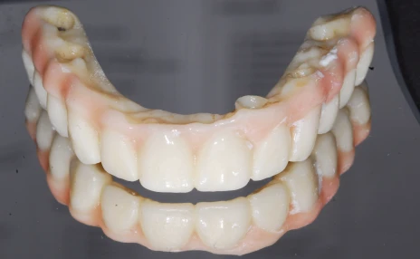 all-on-x example prosthetic