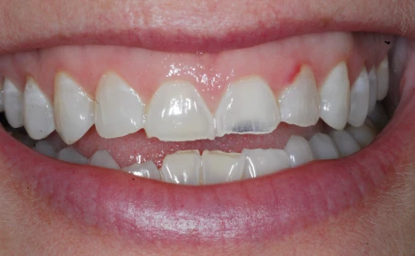 Worn teeth in need of correction