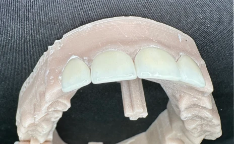 porcelain crowns on model