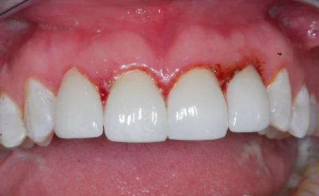 Teeth with 4 porcelain crowns